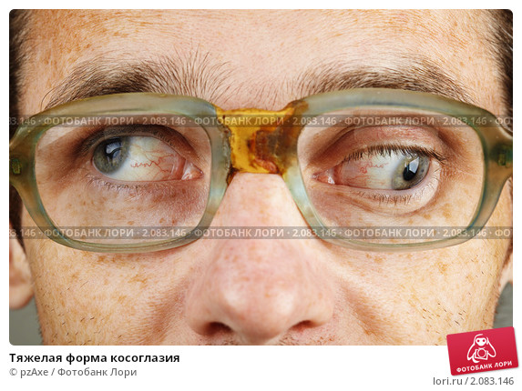 tyazhelaya-forma-kosoglaziya-0002083146-